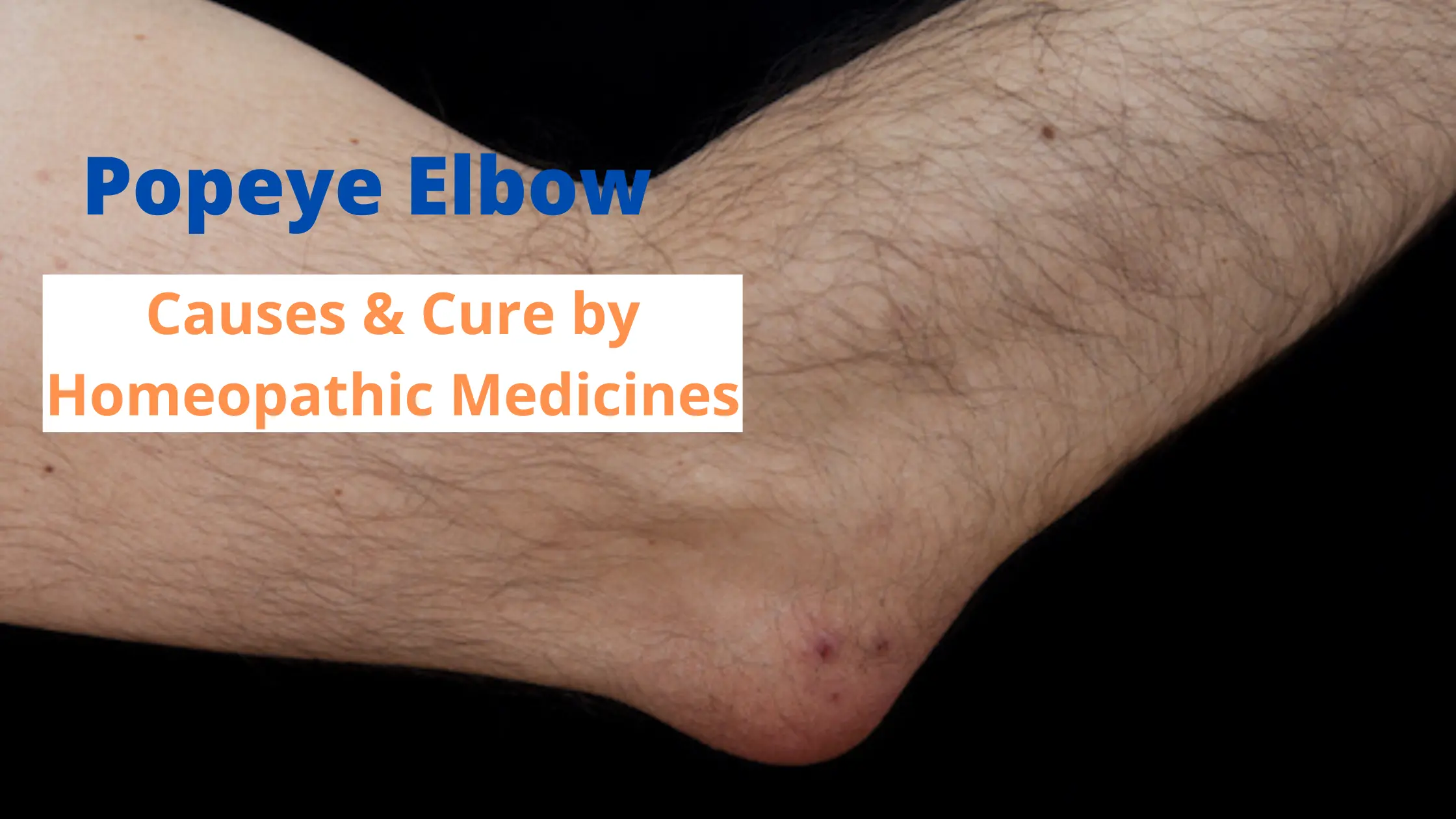 Popeye Elbow Effective Treatment Strategies For Bursitis