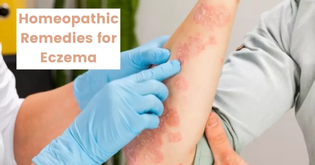 Homeopathic Remedies for Eczema - Symptoms, Medicines and Treatment