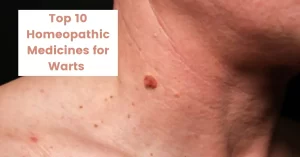 Homeopathic Wart Treatment- Causes & 10 Best Medicines