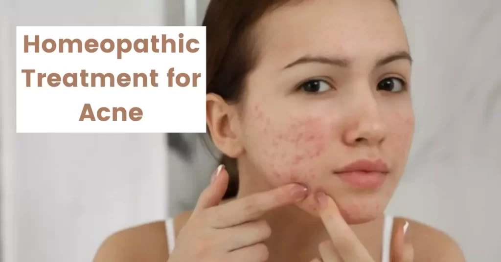 Homeopathy For Acne- Causes, Symptoms and Treatments