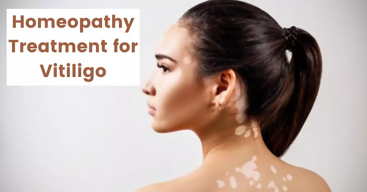 Homeopathy for Vitiligo - Causes, Symptoms and Medicines
