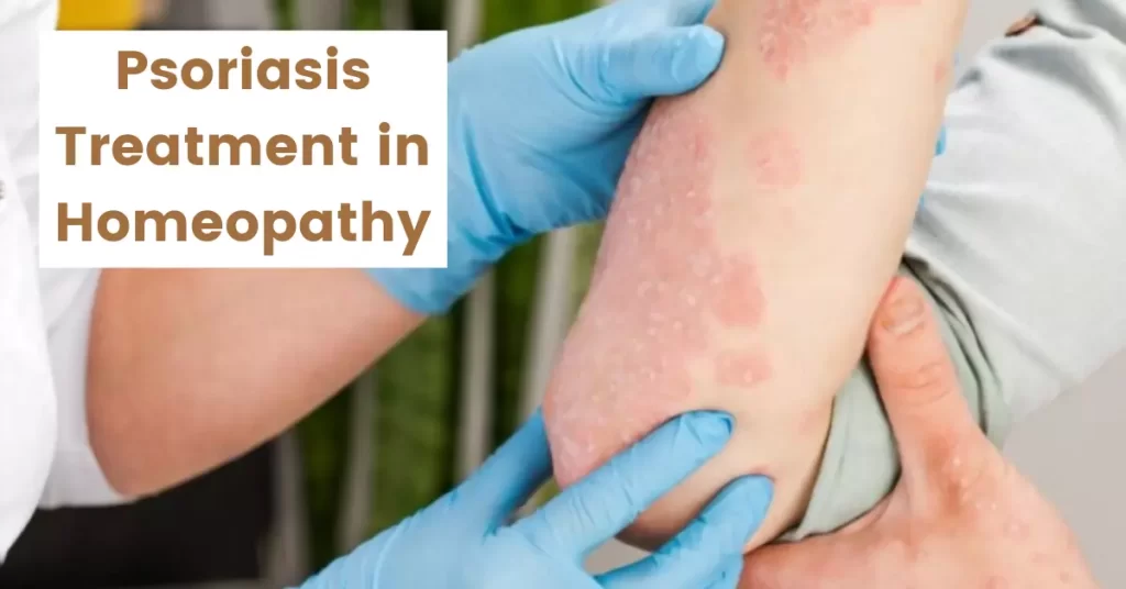 Psoriasis treatment in homeopathy - Causes, Symptoms, Types and Medicines