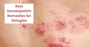 Homeopathy for Shingles - Symptoms, Causes and Best 10 Remedies