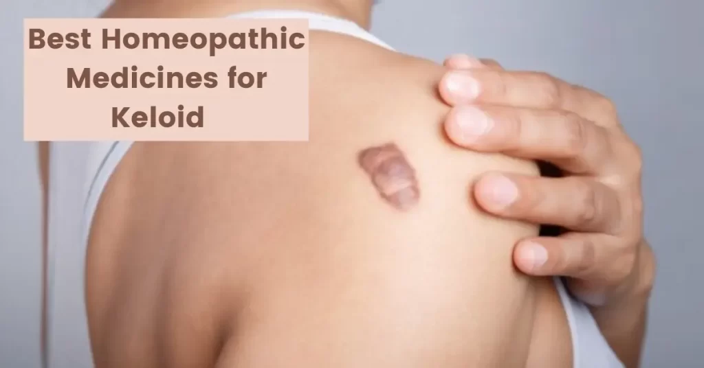 15 Best Homeopathic Keloid Medicine - Removal and Treatment