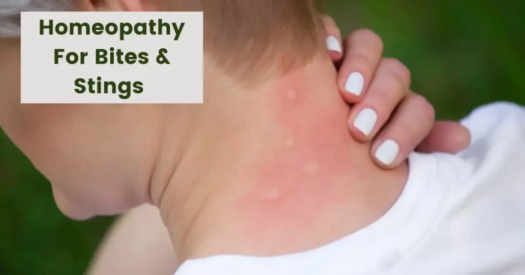 Homeopathy for Bites and Stings - Best 10 Medicines