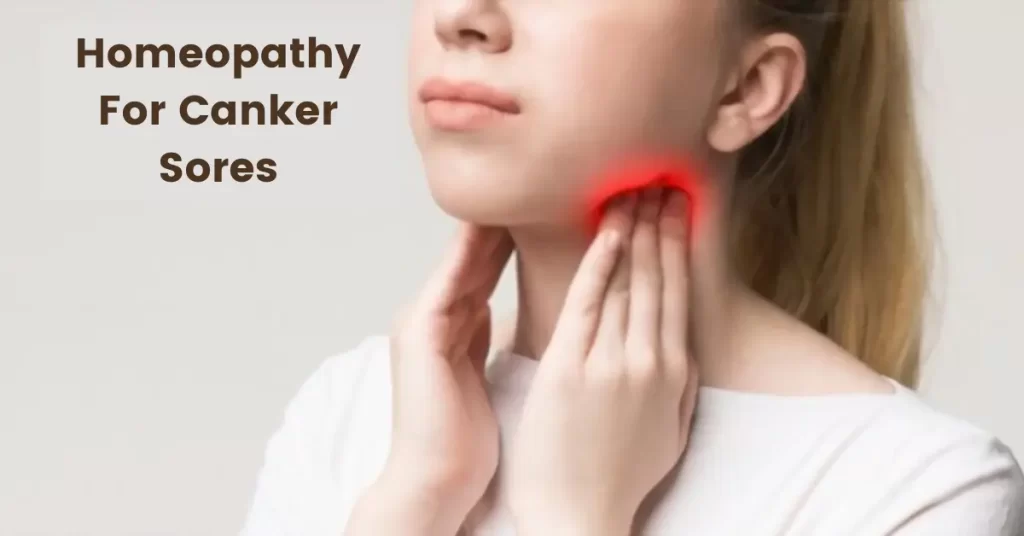 Homeopathy for Canker Sores - Causes, Symptoms and Medicines