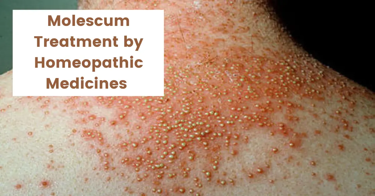 Molescum - Symptoms, Causes and Best Homeopathic Medicines