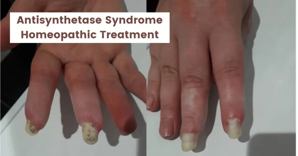 Antisynthetase Syndrome - Symptoms and Homeopathic Treatment