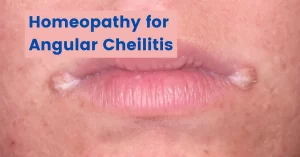 Homeopathy for Cracks In Corner Of Mouth (Angular Cheilitis)