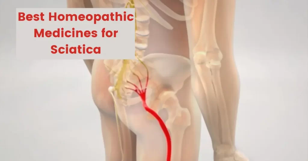 Homeopathy for Sciatica - Symptoms, Causes and Best Medicines