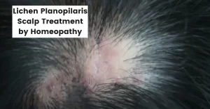 Lichen Planopilaris Scalp Treatment by Homeopathy