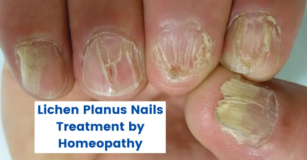 Lichen Planus Nails - 10 Best Homeopathic Treatment
