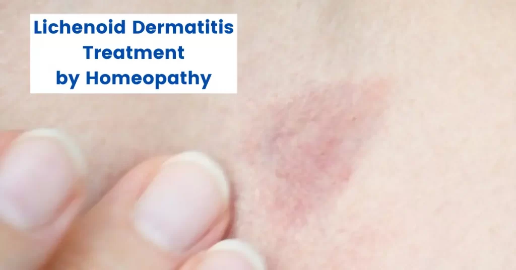 Lichenoid Dermatitis Treatment - Best Homeopathic Medicines