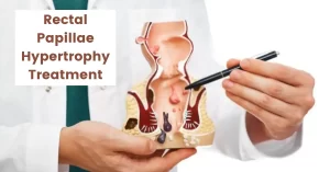 Rectal Papillae Hypertrophy – Treatment in Homeopathy