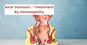 Anal Stenosis – Symptoms, Causes & 10 Homeopathic Medicines