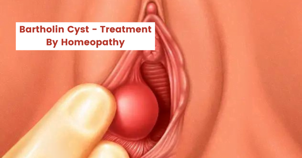 Bartholin Cyst - Treatment and Top 10 Homeopathic Medicines