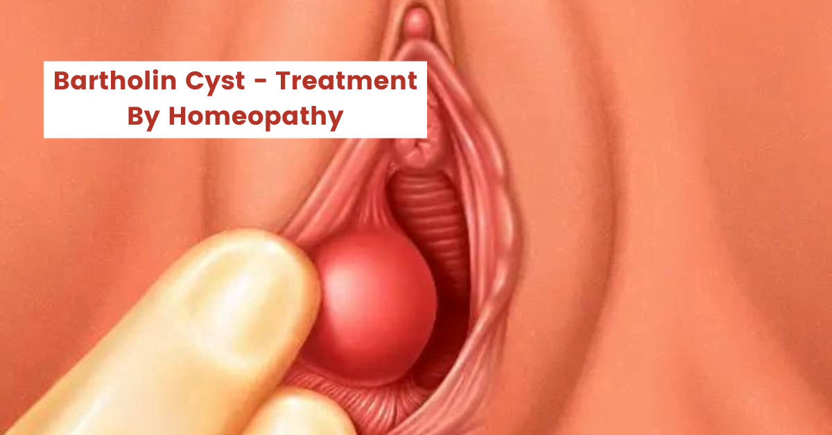 Bartholin Cyst - Treatment and Top 10 Homeopathic Medicines
