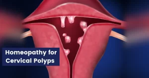 Cervical Polyps - Symptoms, Causes and Homeopathic Remedies