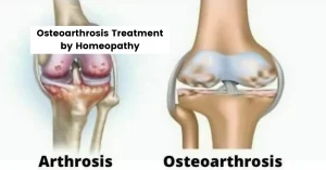 Osteoarthrosis – Symptoms, Causes & Treatment by Homeopathy