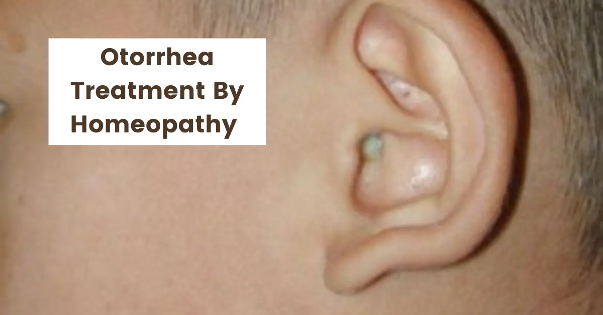 Otorrhea - Definition, Causes and Homeopathic Treatment
