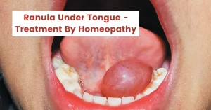 Ranula Under Tongue - Best Treatment By Homeopathy