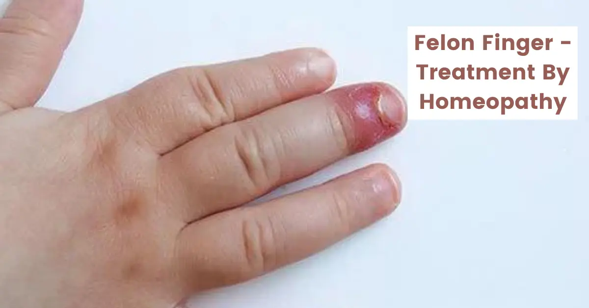 Felon Finger Infection - Causes Treatment by Homeopathy