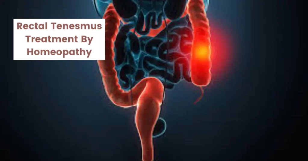 Rectal Tenesmus - Causes and Best Treatment by Homeopathy
