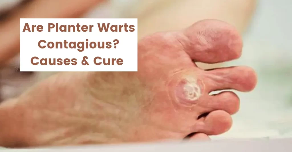 Are Plantar Warts Contagious - Causes and Cure by Homeopathy