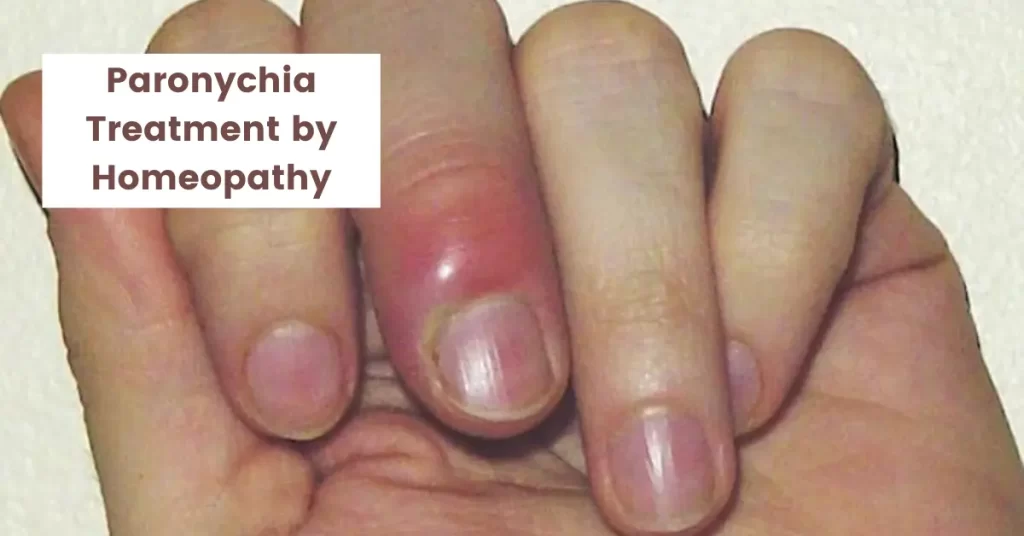Paronychia Treatment - Causes and Top 10 Homeopathic Medicines