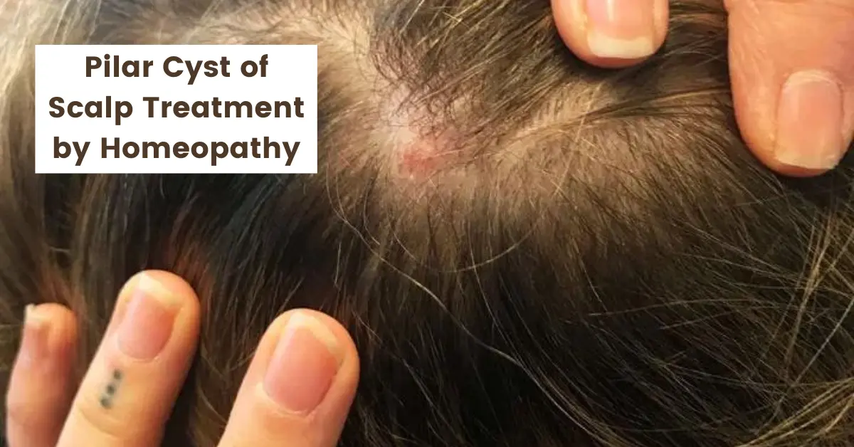 Pilar Cyst of Scalp - Causes and Best Treatment by Homeopathy