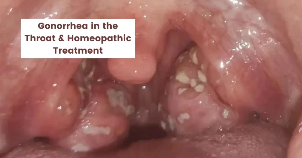 Gonorrhea in the Throat and its Best Homeopathic Treatment