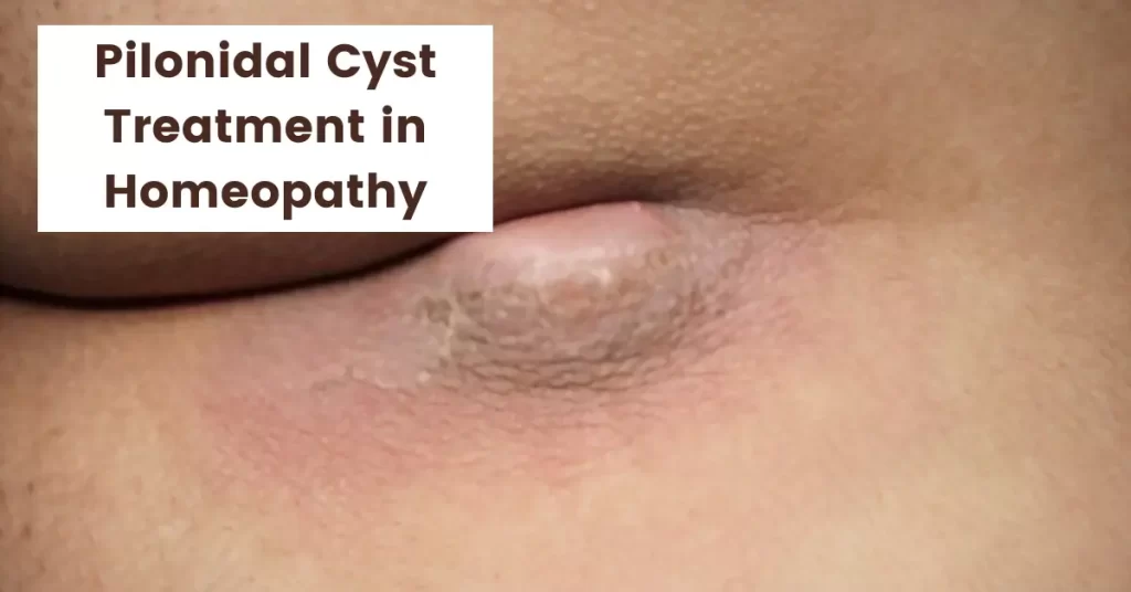Pilonidal Cyst - Causes, Symptoms and Treatment in Homeopathy