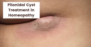 Pilonidal Cyst – Causes, Symptoms & Treatment in Homeopathy