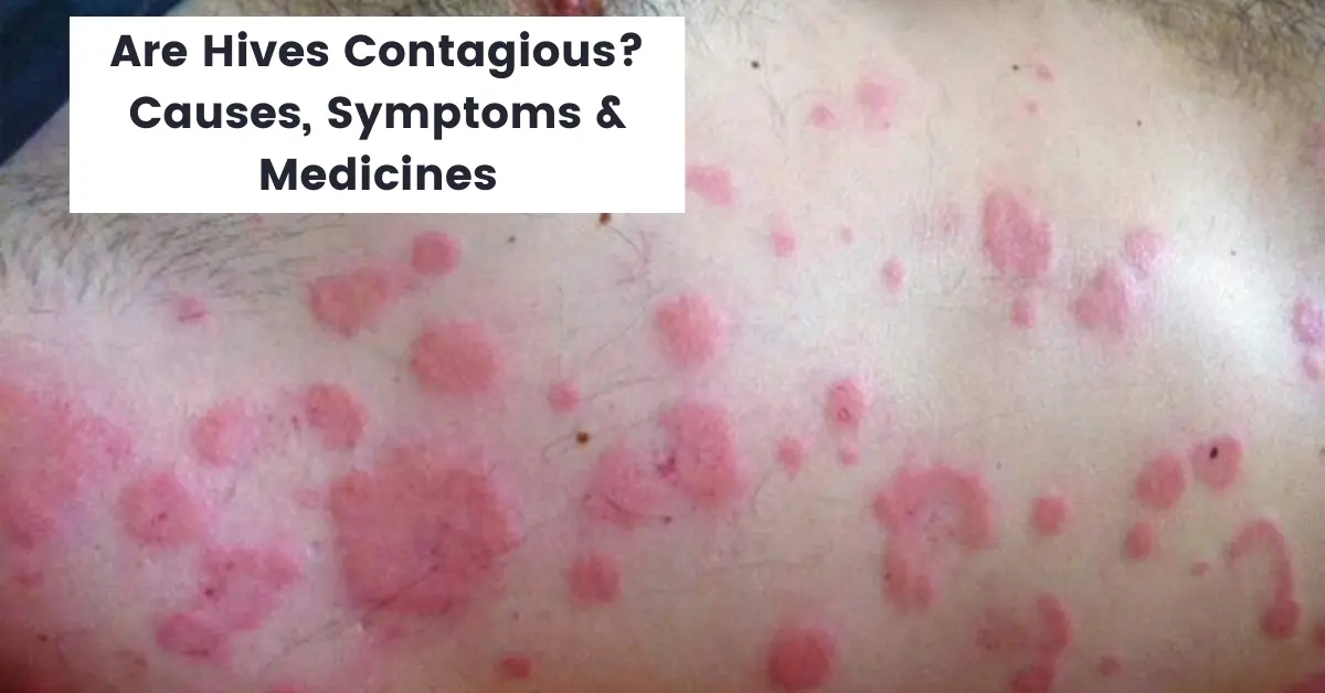 Are Hives Contagious Causes, Symptoms and Homeopathy Medicine