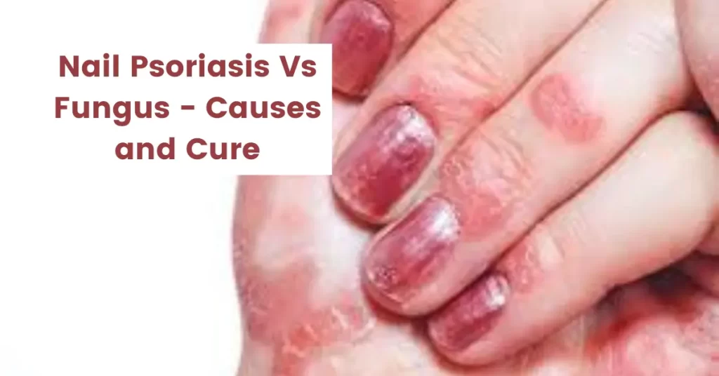 Nail Psoriasis Vs Fungus - Causes, Symptoms and Best Homeopathic Medicines