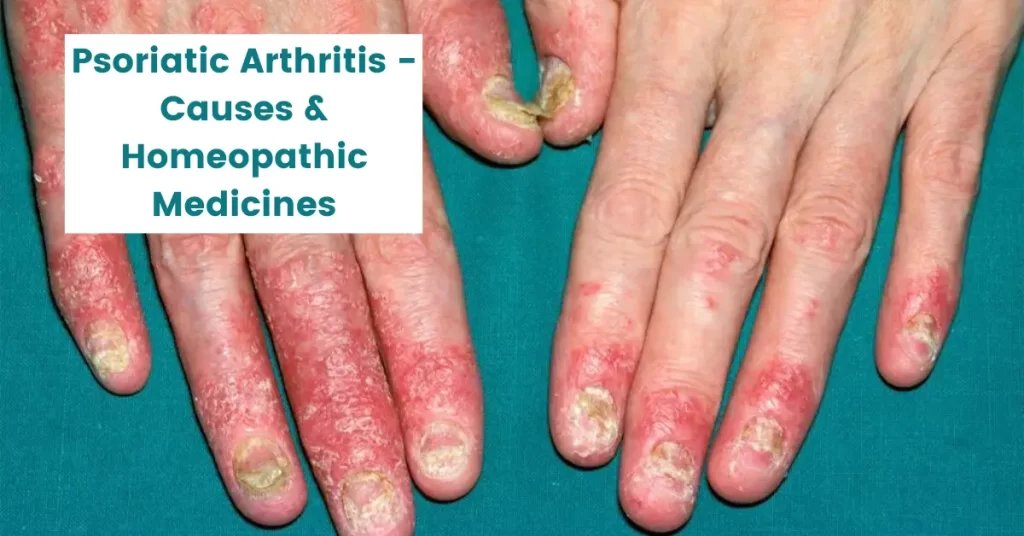 Psoriatic Arthritis - Causes and 11 Best Homeopathic Medicines