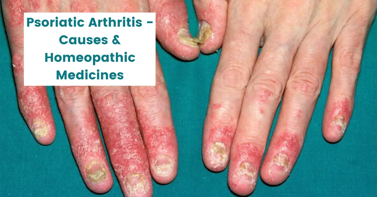 Psoriatic Arthritis - Causes and 11 Best Homeopathic Medicines