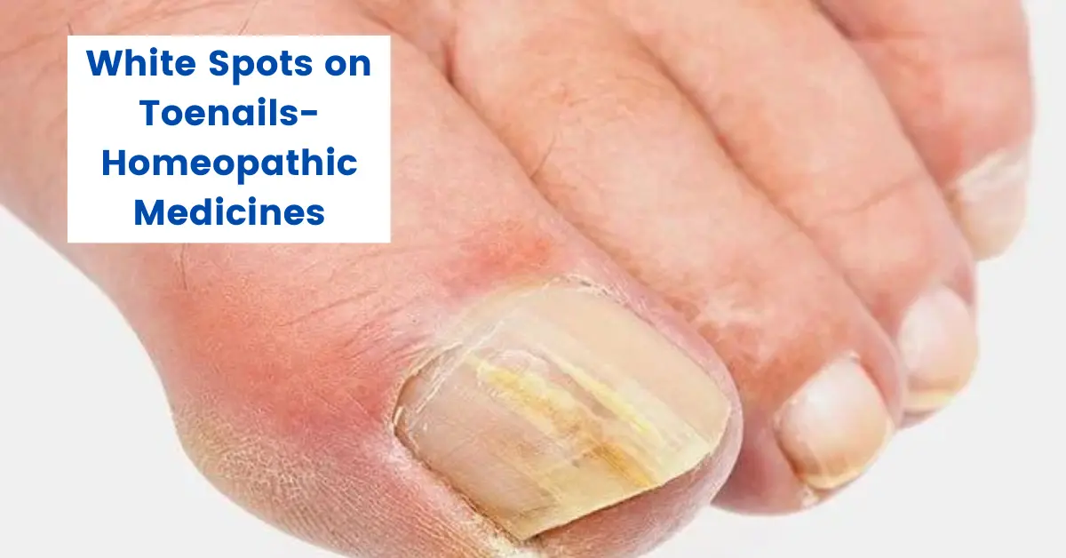 White Spots on Toenails- Causes and Best Homeopathic Medicines