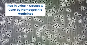 Pus in Urine Treatment - Causes and Homeopathy Medicines