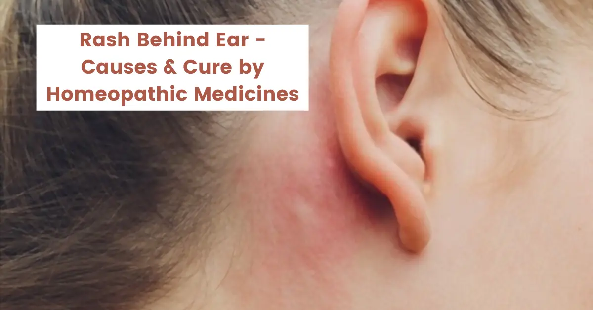 Rash Behind Ear Causes Treatment By Homeopathy Medicines