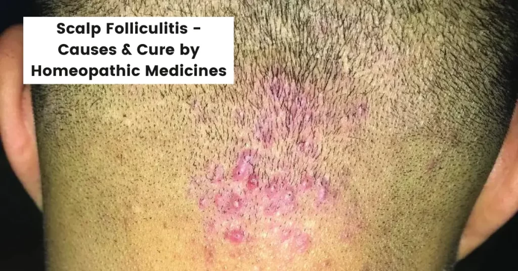 Scalp Folliculitis Treatment - Causes and Cure by Homeopathy