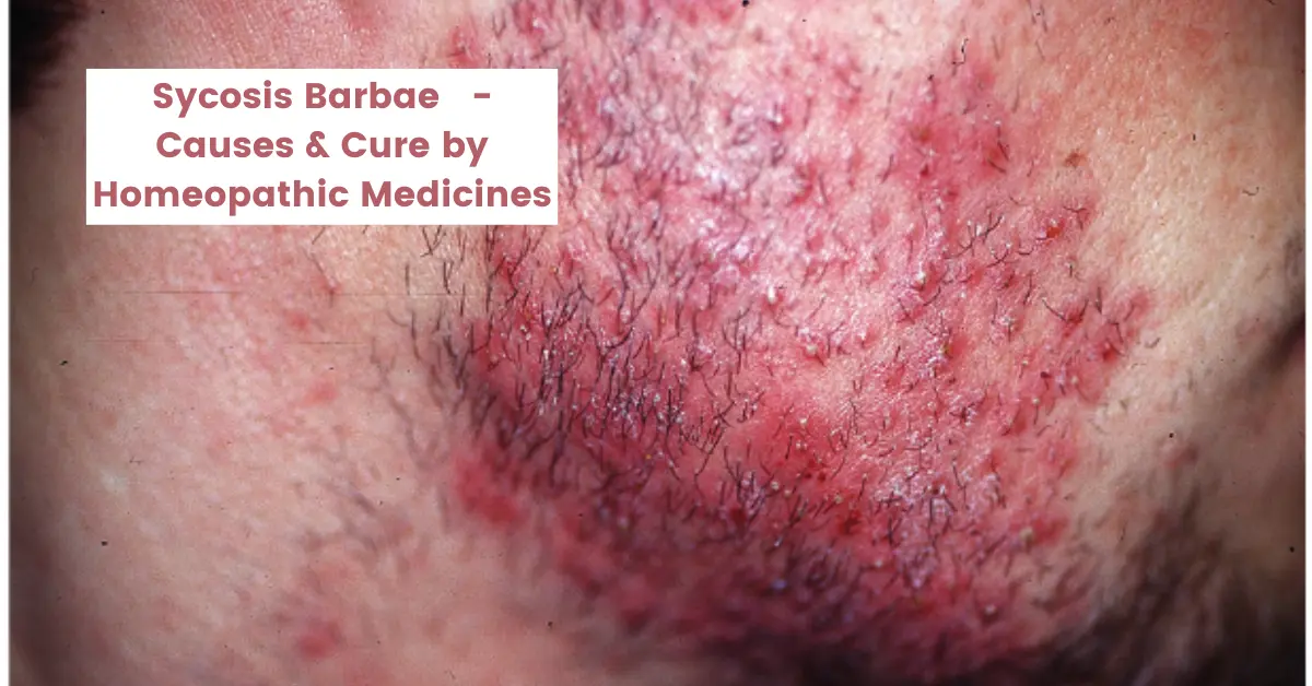 Sycosis Barbae - Causes, Symptom, Best Homeopathic Medicine