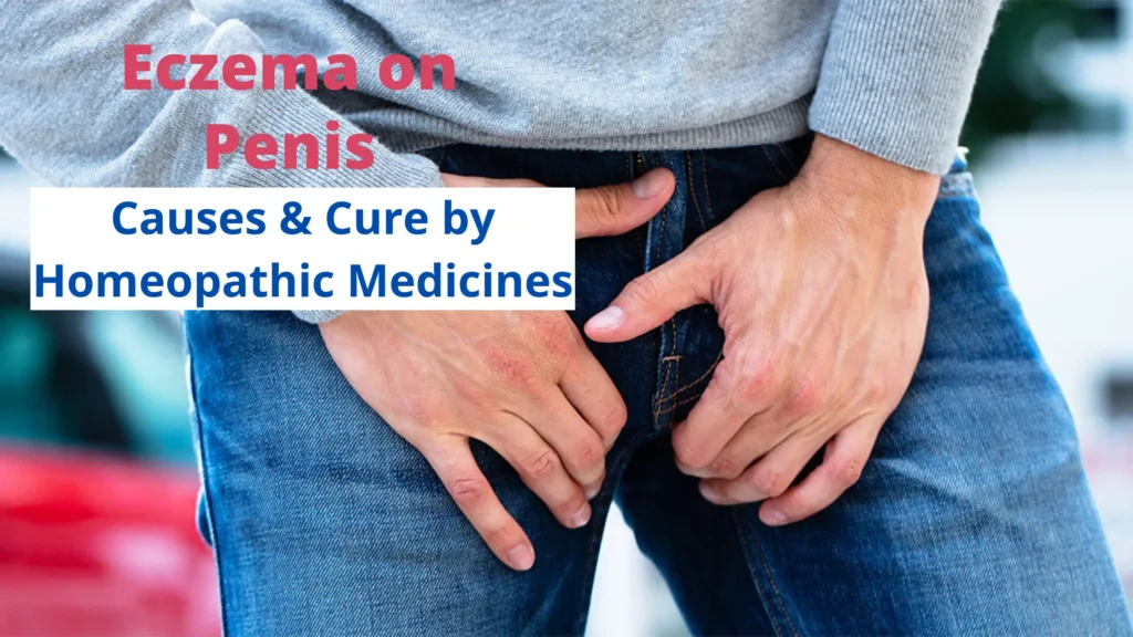 Eczema On Penis – Symptoms, Causes and Homeopathy Treatment