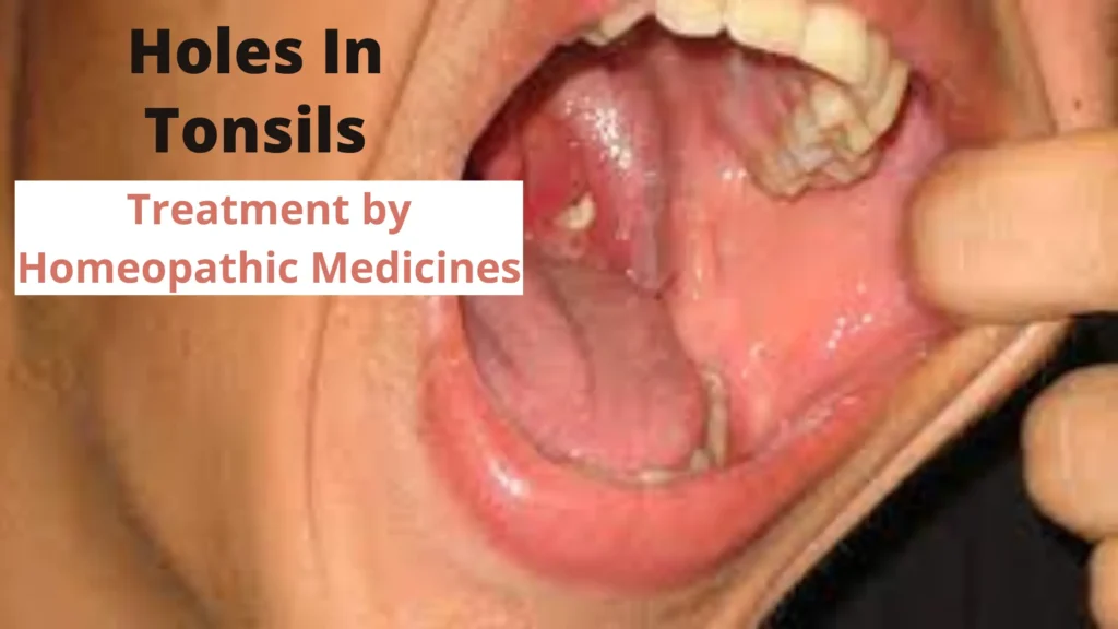 Holes In Tonsils – Symptoms, Causes and Homeopathy Treatment