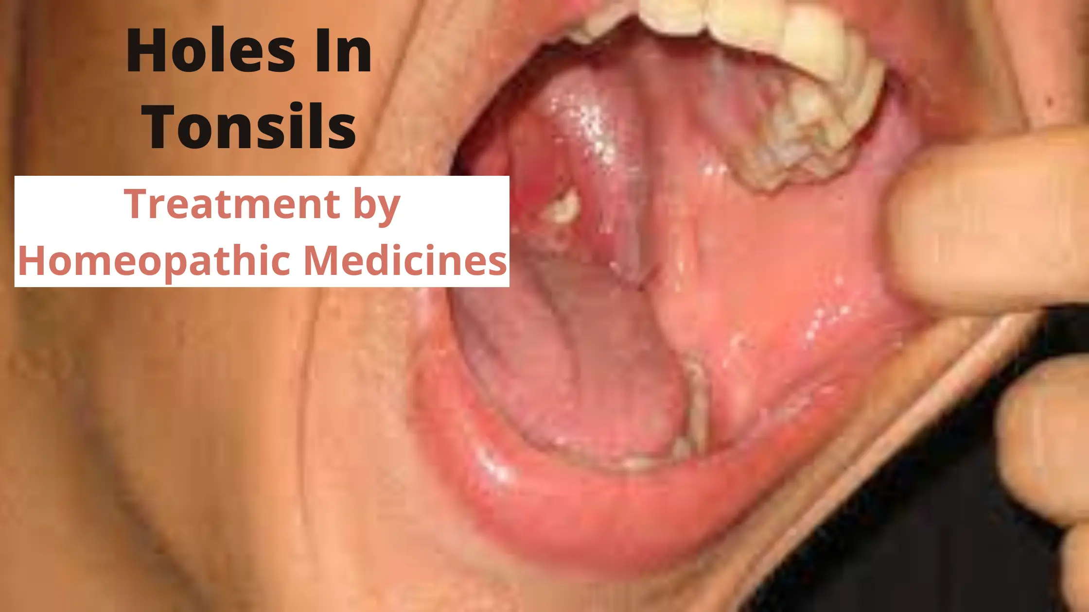 Holes In Tonsils Symptoms Causes Homeopathy Treatment