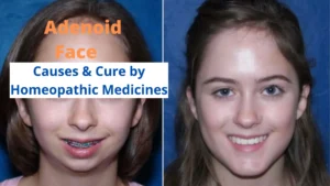 Adenoid Face – Causes and Treatment by Homeopathic Medicines