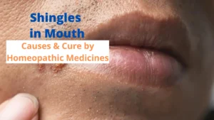Shingles in Mouth– Symptoms, Causes and Homeopathic Medicines