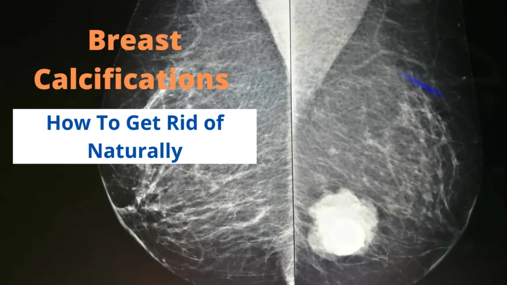 How To Get Rid of Breast Calcifications Naturally