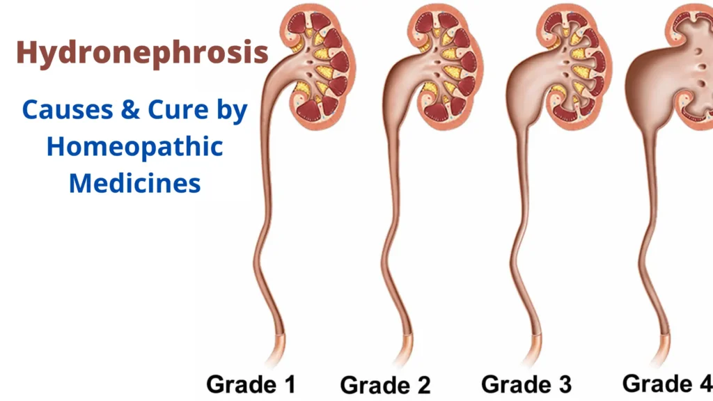 Hydronephrosis - Causes and Best Homeopathic Medicines