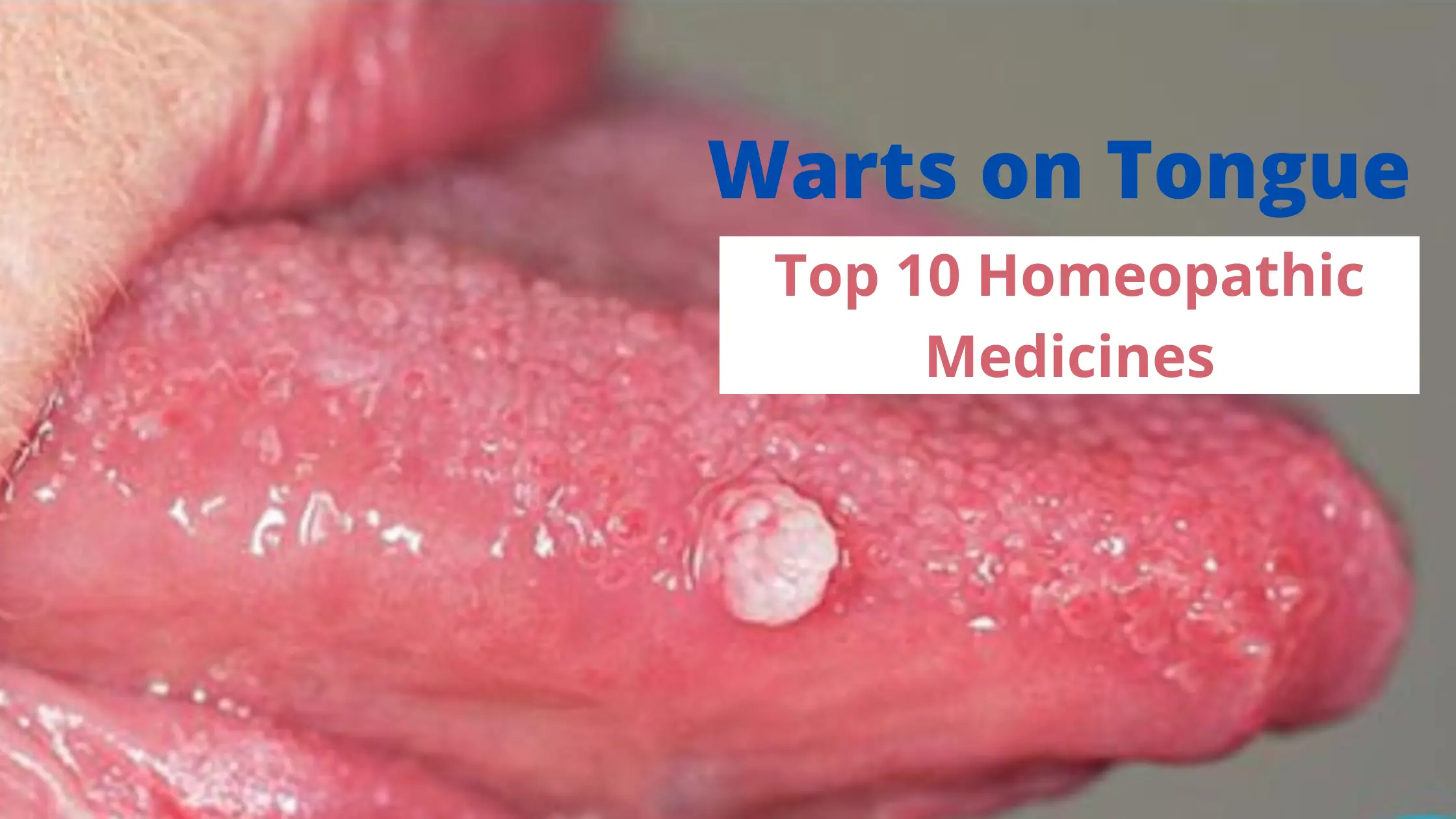 Warts on Tongue - Causes & Best 10 Homeopathic Medicines